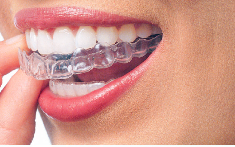Invisalign Prices uk average
