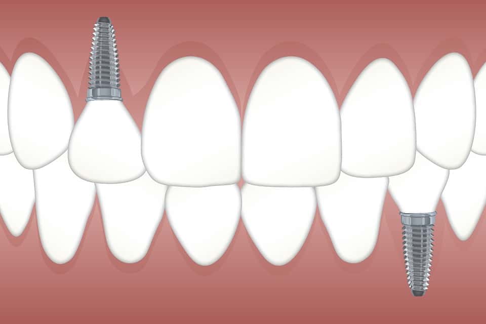 Single Tooth Implant Prices – Regional