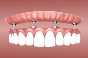 dental implant prices uk average