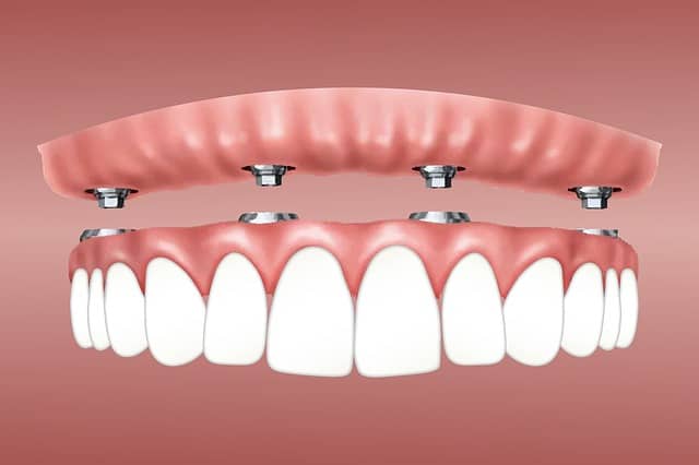 dental implant prices uk average